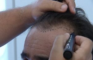 Διαδικασία μεταμόσχευσης μαλλιών