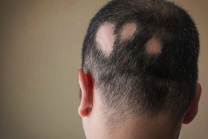 Αλωπεκια γυροειδης