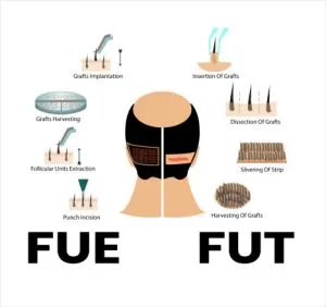 Διαφορές FUE και FUT STRIP